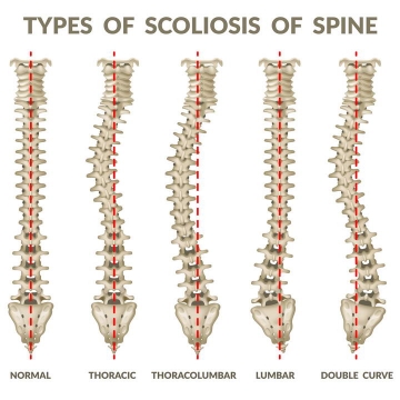 5种不同形态的脊椎弯曲脊柱图片免抠素材