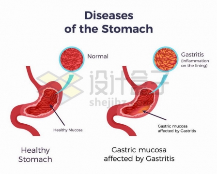 人体正常的胃部和胃炎对比图png图片免抠矢量素材