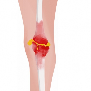 膝盖肿块类风湿性关节炎骨头疼插画482984png图片素材