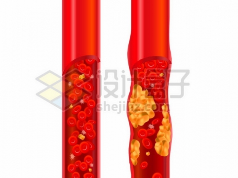 正常血管和脂肪堆积的血管解剖图753437png矢量图片素材