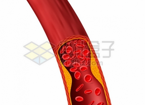 脑血栓脂肪堆积血管解剖图808487png矢量图片素材